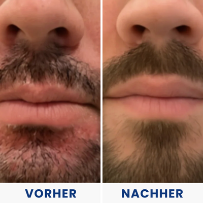 Hulemo® Die Lösung bei gereizter Haut und Schuppen