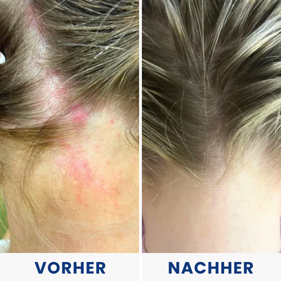 Hulemo® Die Lösung bei gereizter Haut und Schuppen