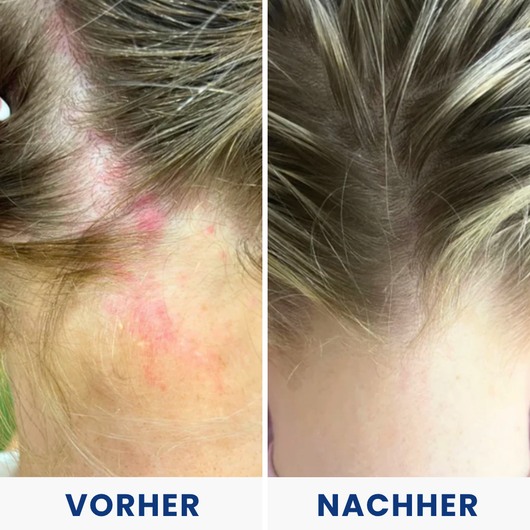 Hulemo® Die Lösung bei gereizter Haut und Schuppen