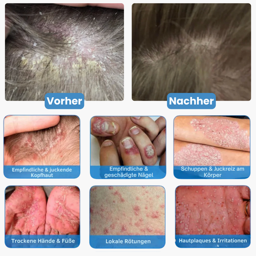 Hulemo® Die Lösung bei gereizter Haut und Schuppen