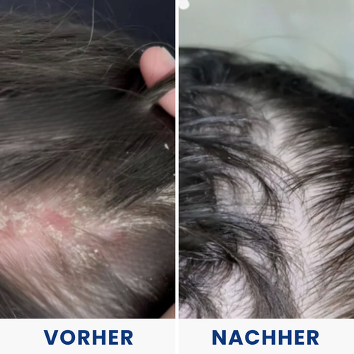 Hulemo® Die Lösung bei gereizter Haut und Schuppen