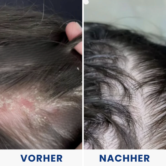 Hulemo® Die Lösung bei gereizter Haut und Schuppen