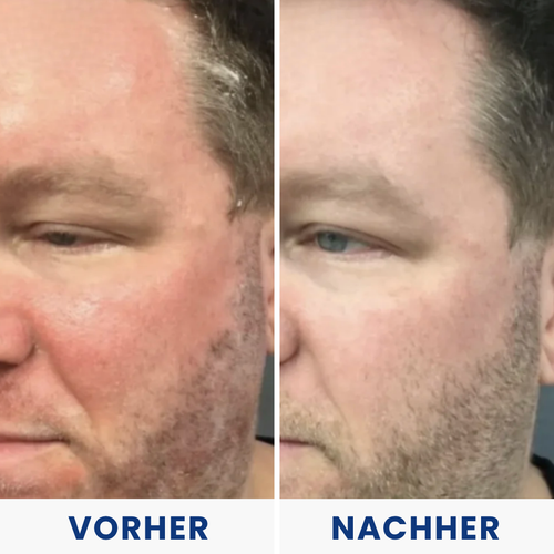 Hulemo® Die Lösung bei gereizter Haut und Schuppen