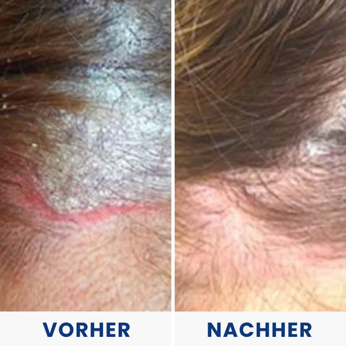 Hulemo® Die Lösung bei gereizter Haut und Schuppen