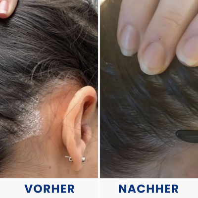 Hulemo® Die Lösung bei gereizter Haut und Schuppen